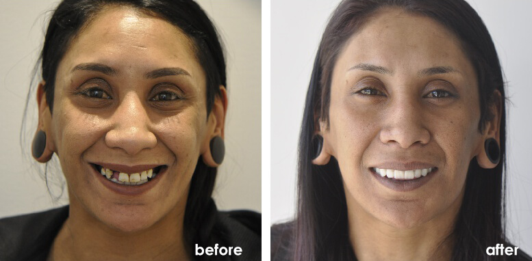 extreme makeover before and after teeth